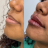 Preenchimento Labial