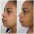 Lipoaspiração facial com fio de sustentação