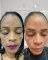 Tratamento de Melasma