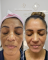 Tratamento de Melasma
