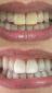 Clareamento Dental