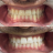 Clareamento Dental