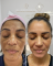 O que é Melasma?