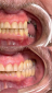Quantos dias de repouso após implante dentário?