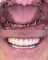 Prótese Protocolo Dentário: Quanto Tempo Dura e Vale a Pena?