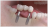Faltando um ou mais dentes? Implante dentário é a solução definitiva! 🦷