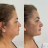 Emagrecimento facial HD
