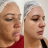 Tratamento de melasma Ultragold
