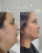 Lipo de Papada HD
